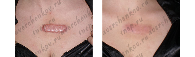 Krioterapija rubcy-keloid5-6.jpg