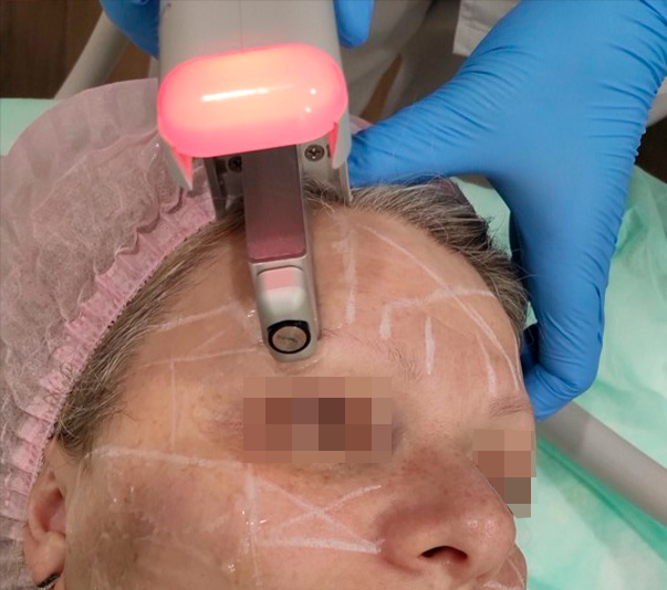 Сканирование области лба