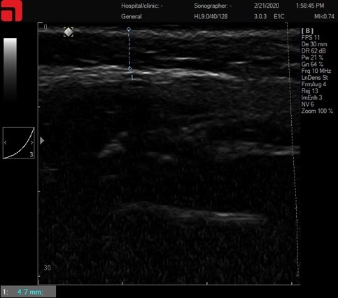 Асимметрия лица – асимметрия SMAS