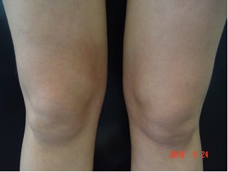 Лифтинг кожи, уменьшение объемов бедер, коленей и проявлений целлюлита через 2 месяца после начала курса (проведено 4 процедуры). Лифтинг кожи, уменьшение объемов бедер, коленей и проявлений целлюлита через 2 месяца после начала курса (проведено 4 процедуры).