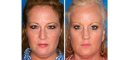  Однояйцевые близнецы