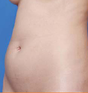 до липосакции