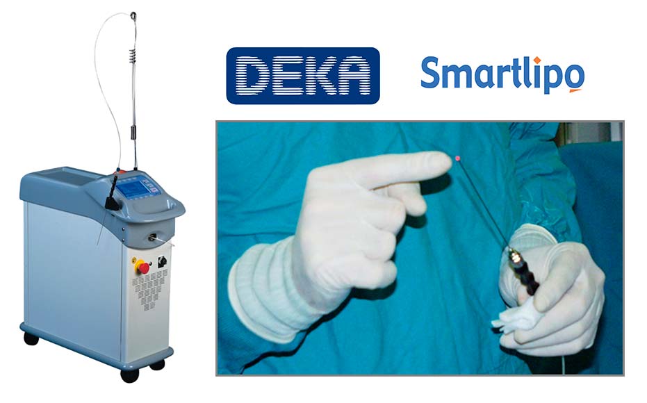 Лазер DEKA SmartLipo lazer_DEKA-SmartLipo