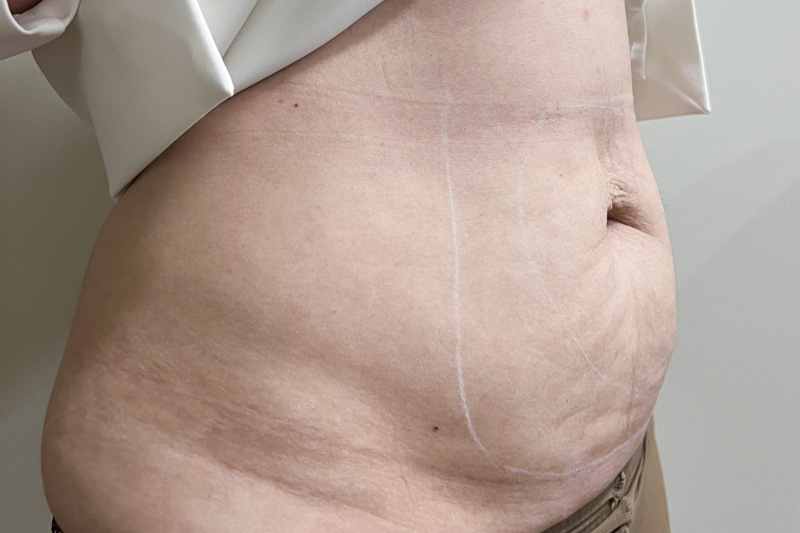 Комбинированный протокол Ulfit + Volnewmer, фото до