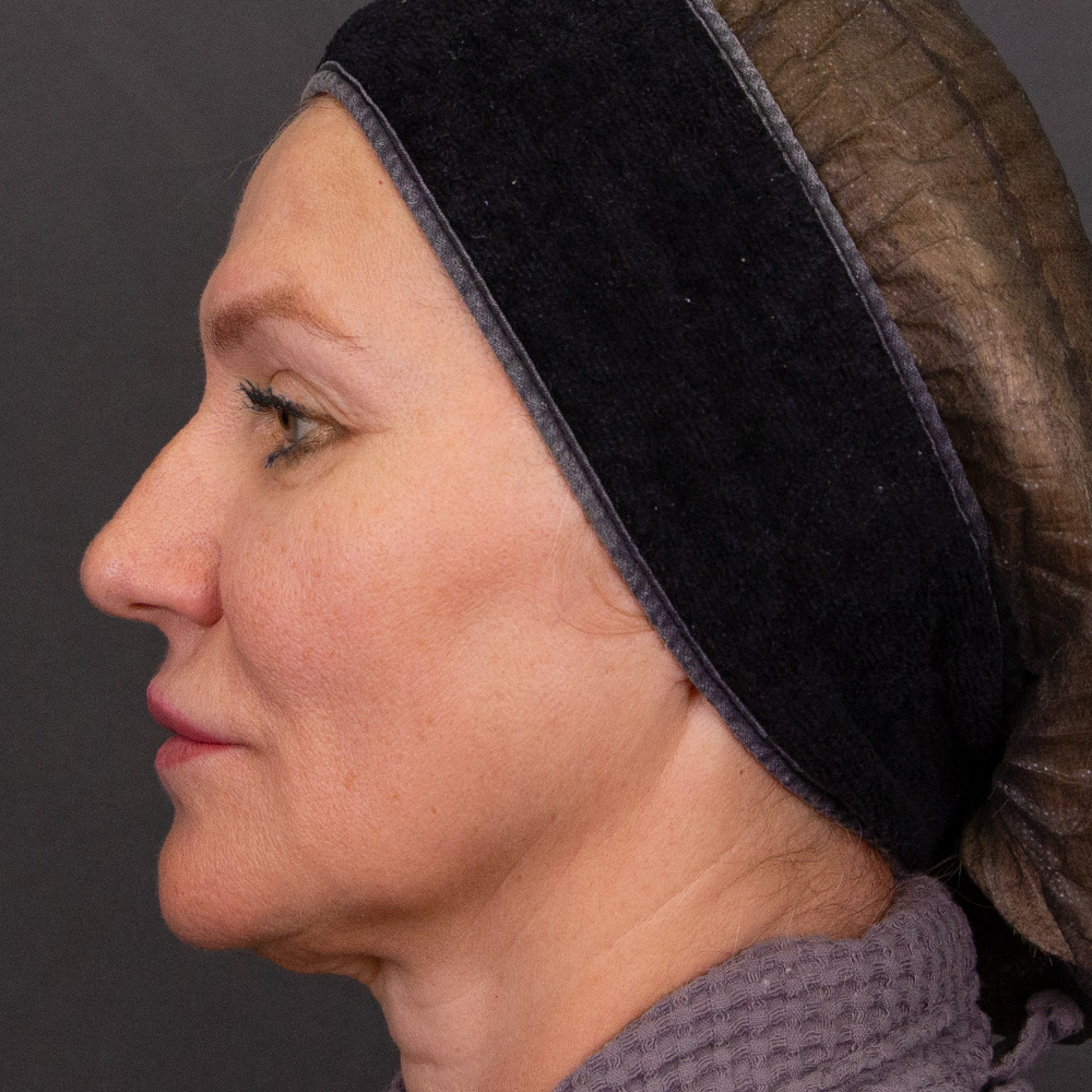 Протокол процедуры Peach Peel PRO и Colibriderm Hydro, фото до