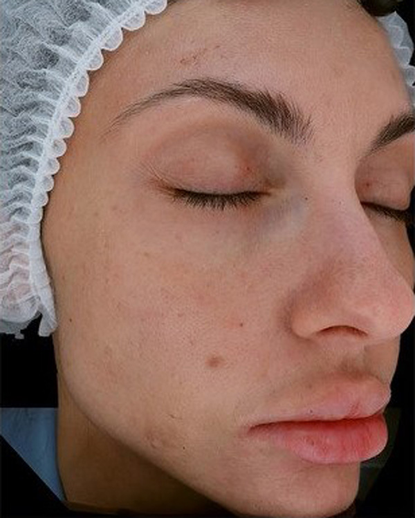 Calecim Professional Serum
