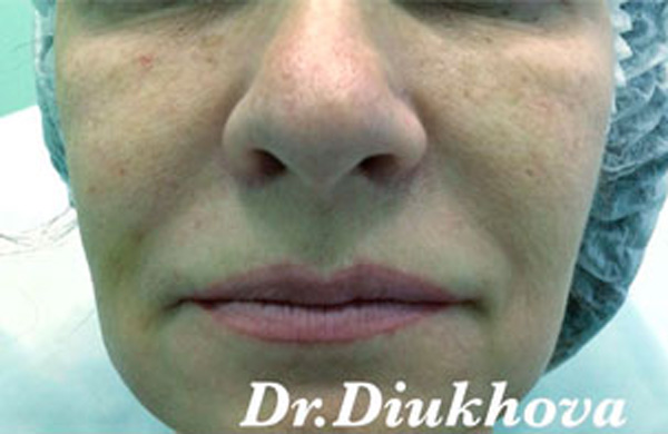 Контурная пластика против малярных мешков