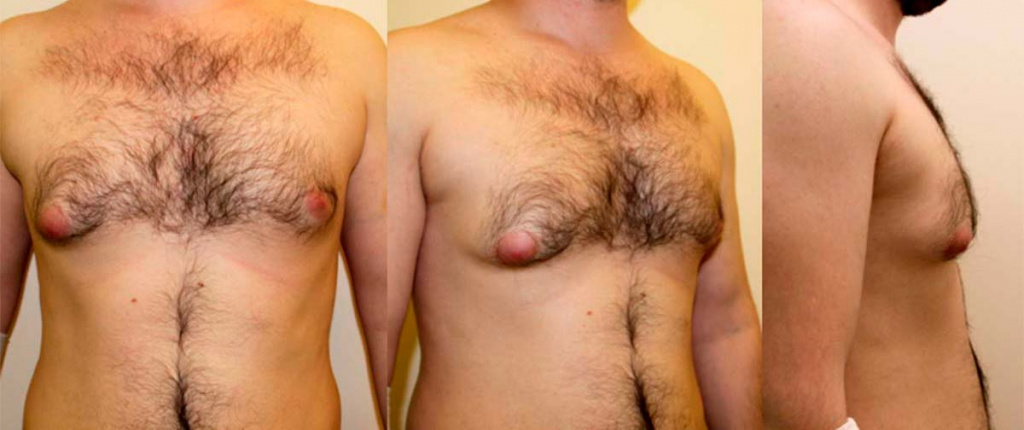Фото до процедуры DEKA SmartLipo do_mastektomii_DEKA-SmartLipo