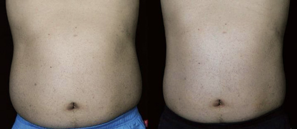 SLIMUS, фото до и после