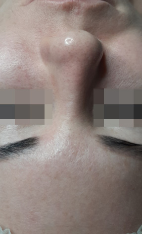 Acless spot peel
