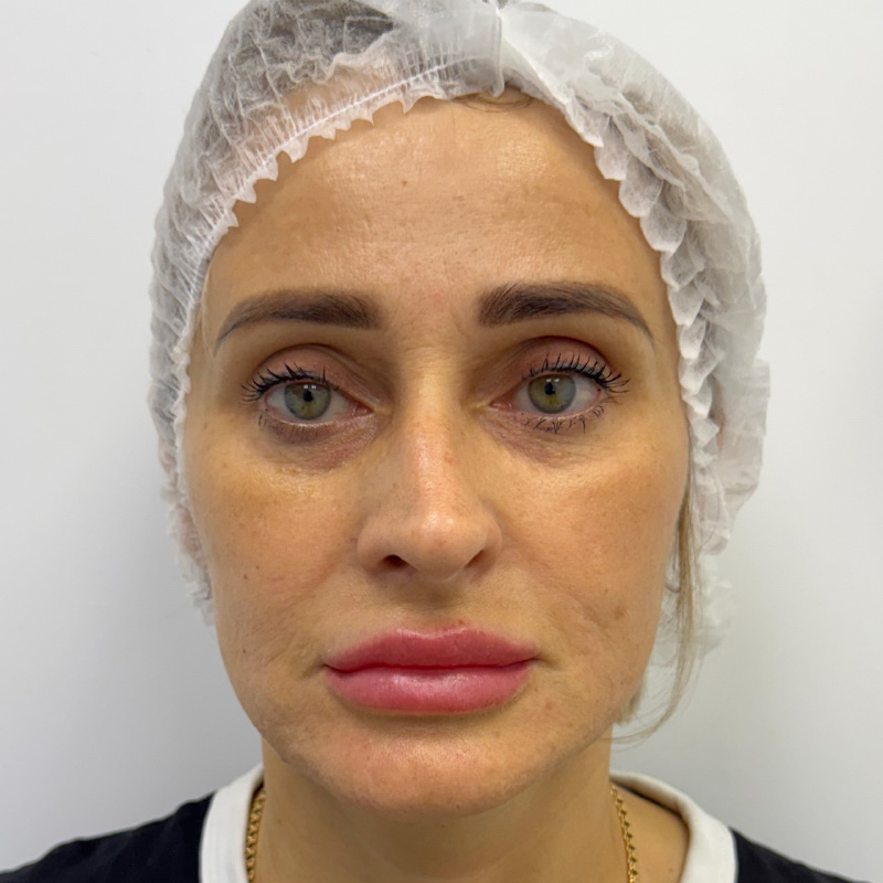 CO₂ лазер + Cellenis PRP, фото После