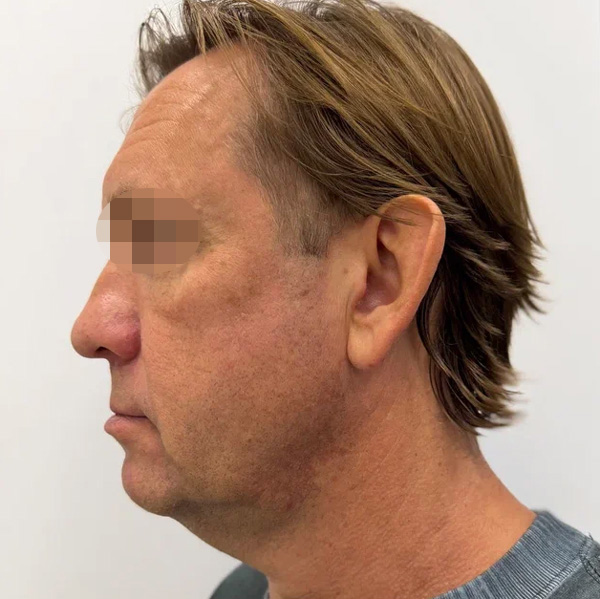 Neauvia Man, фото до и после