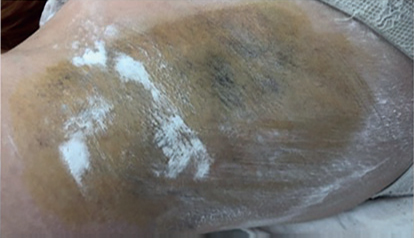 Тест Минора после процедуры