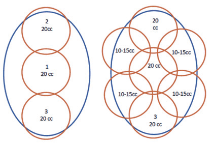 лечение гипергидроза на аппарате MiraDry