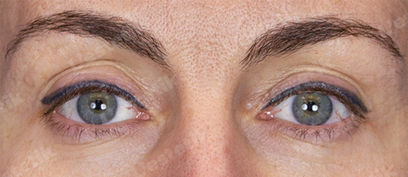 RF-лифтинг Ashley, фото До