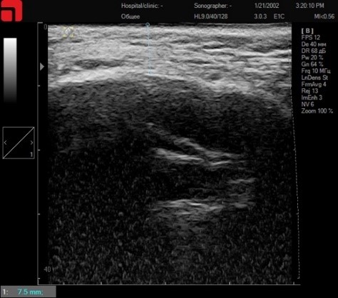 Сканирование скуловой дуги