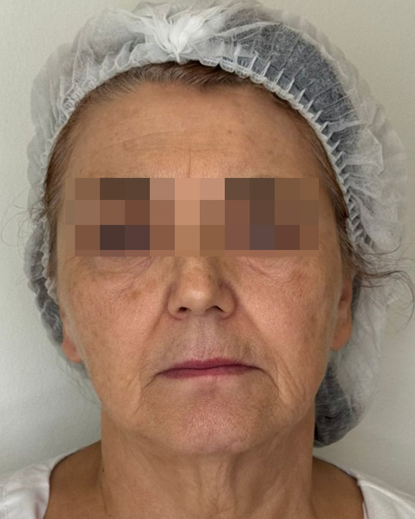 ALMA HYBRID, фото пациента до