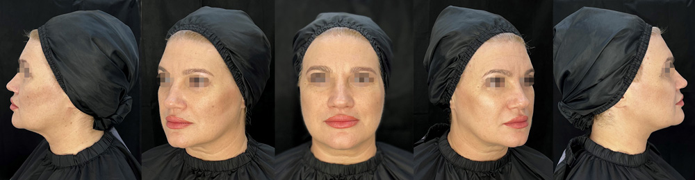 Restylane® Lyft