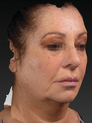 Косая и боковая проекции лица