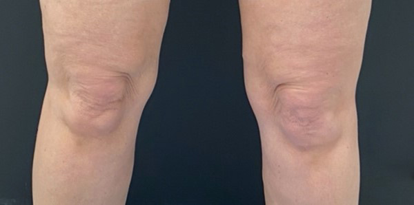 Скульптра плюс криолиполиз