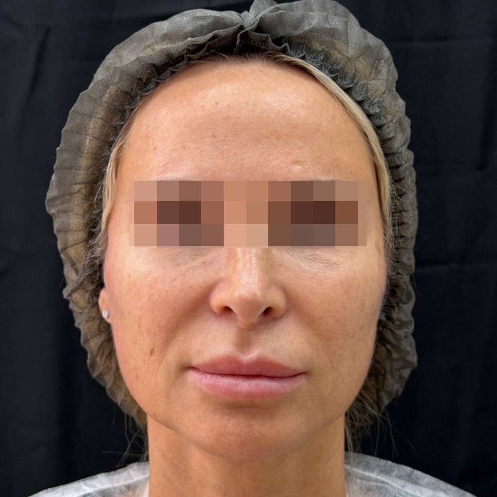 Oligio и Neauvia: фото после