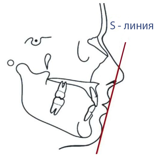 S-line, S-изгиб