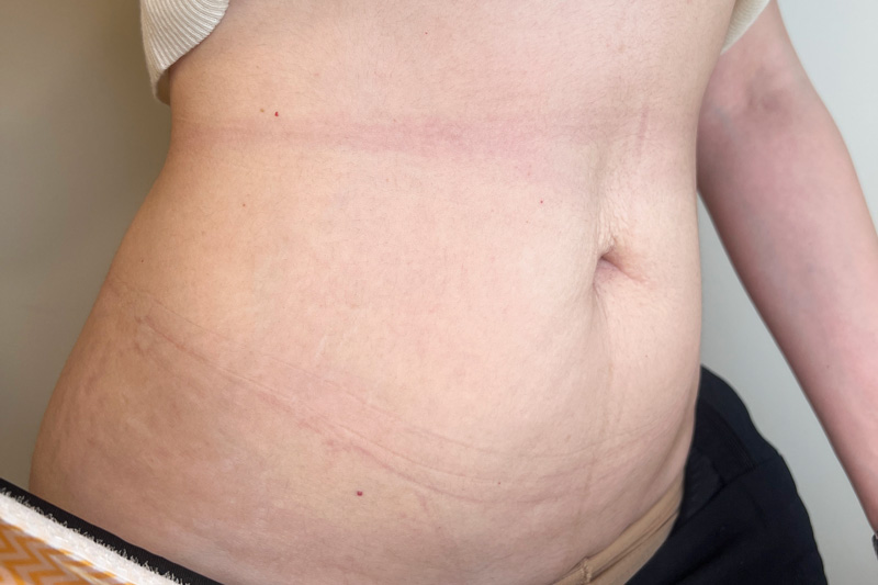 Комбинированный протокол Ulfit + Volnewmer, фото после