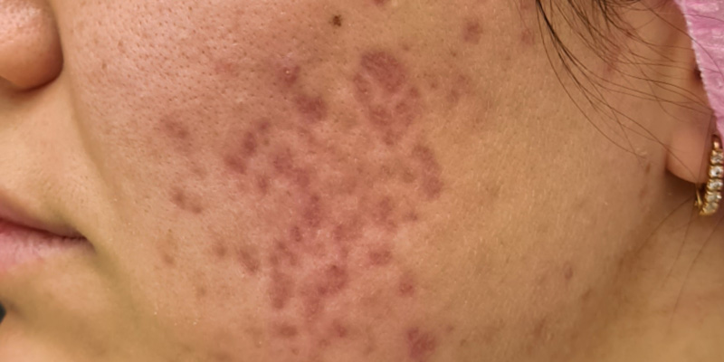 Комбинированная терапия акне