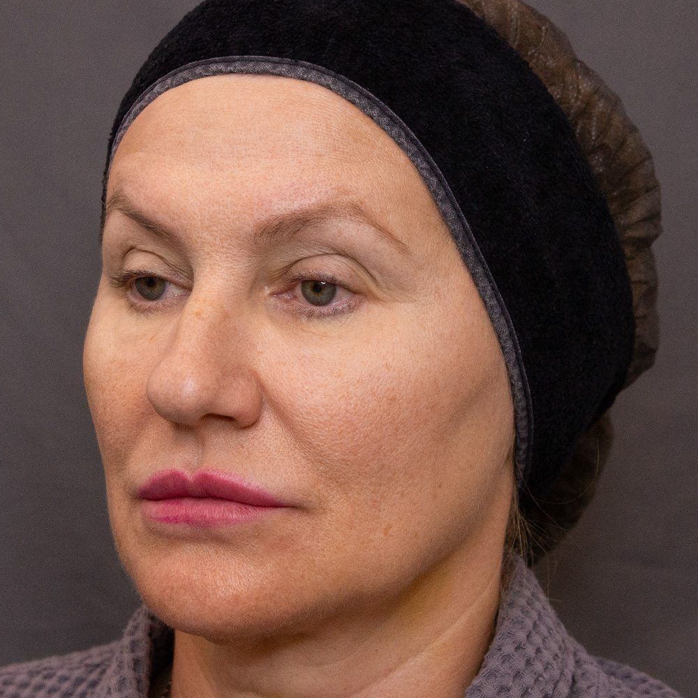 Протокол процедуры Peach Peel PRO и Colibriderm Hydro, фото после