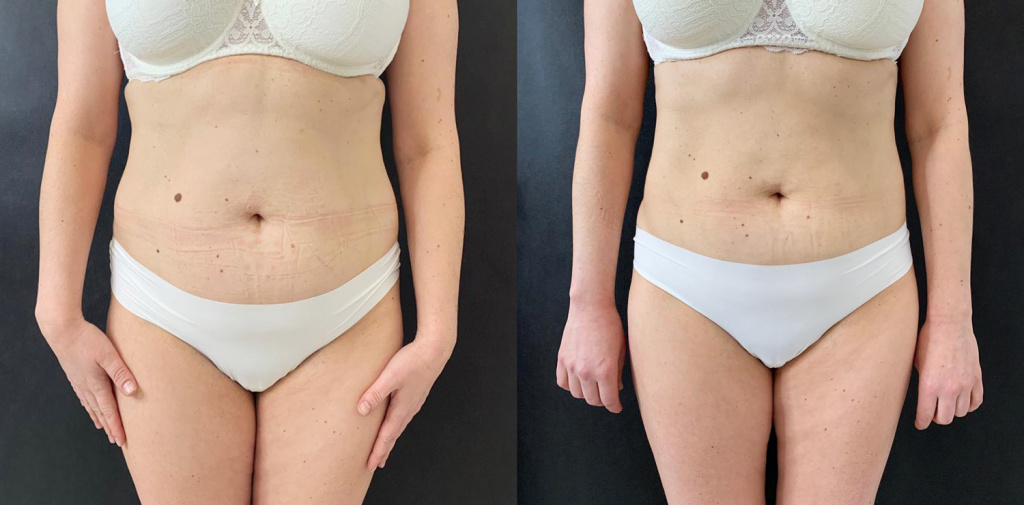 коррекция на аппарате Accent, фото до и после