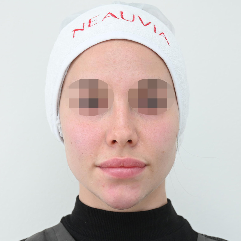 Процедура Fresh&Lift, фото после