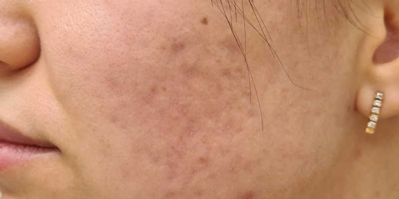 Комбинированная терапия акне