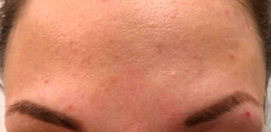 препараты Magiray для коррекции акне