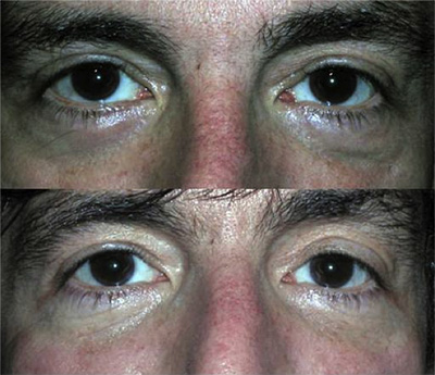 до и после процедуры карбокситерапии, коррекция целлюлита до и после