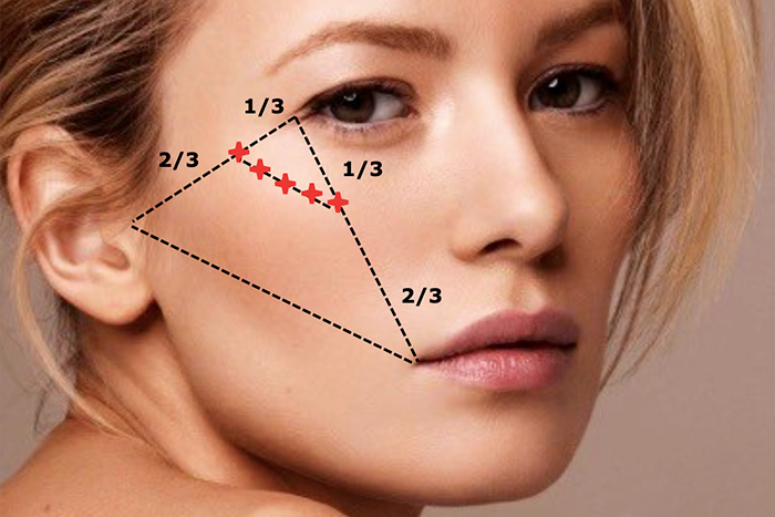 скуловая область, разметка, Restylane Perlane