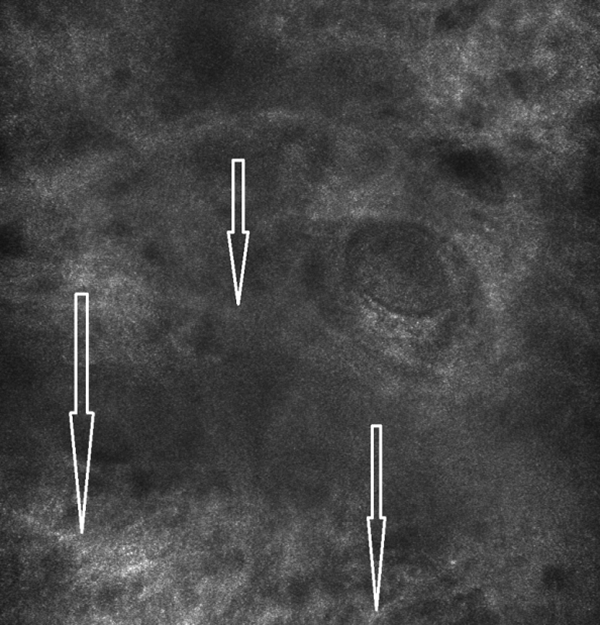 состояние дермы после проведения инъекционного курса АЗТ Jalupro®