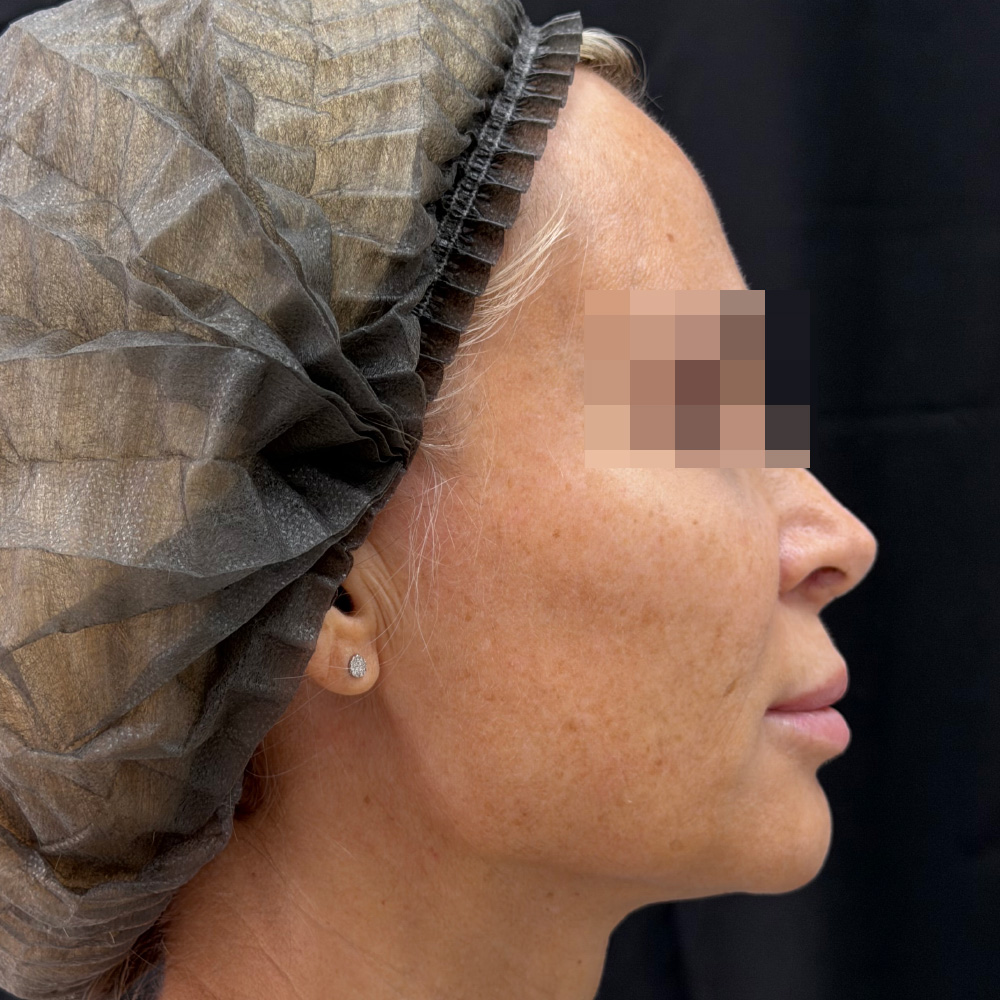 Oligio и Neauvia: фото до