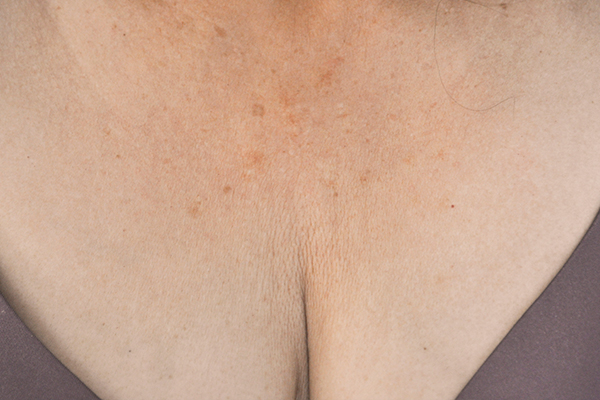 Зона декольте после процедуры на аппарате Exilis Ultra 360™