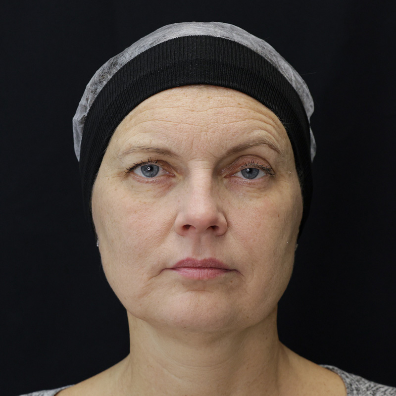 Bioregen Фото до