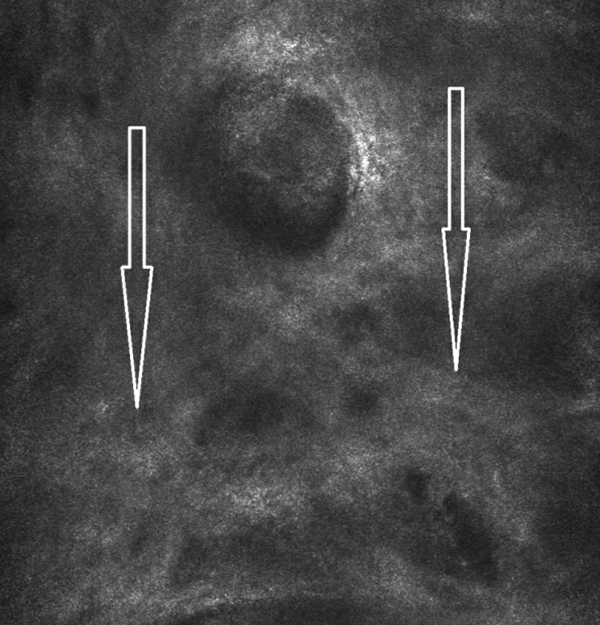 состояние дермы до проведения инъекционного курса АЗТ Jalupro®
