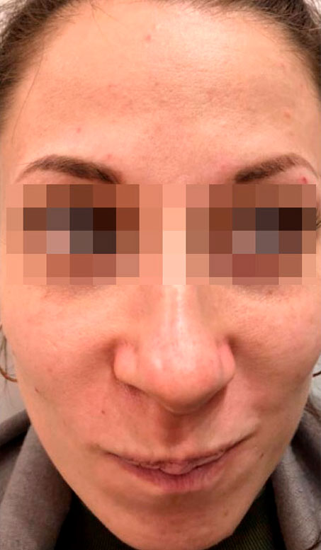 препараты Magiray для коррекции акне