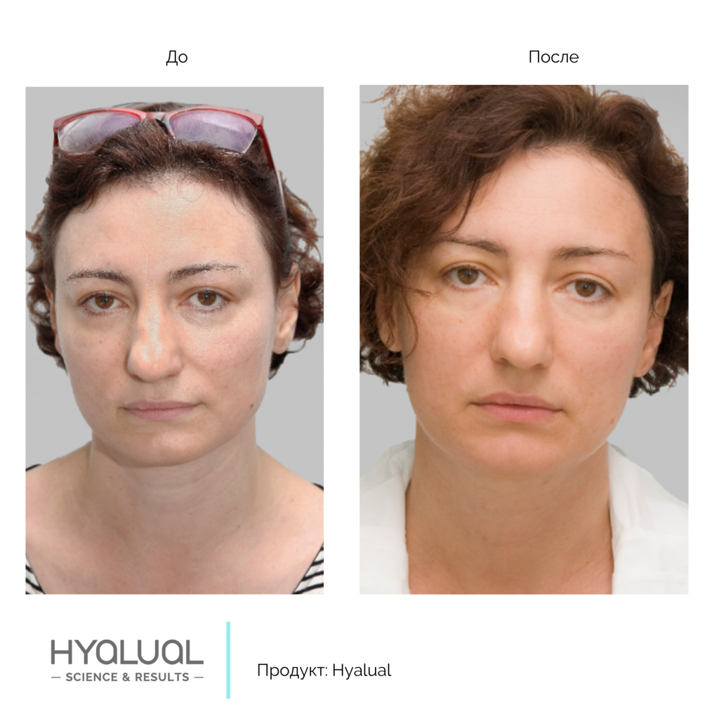 Hyalual 2,2 %, фото до и после