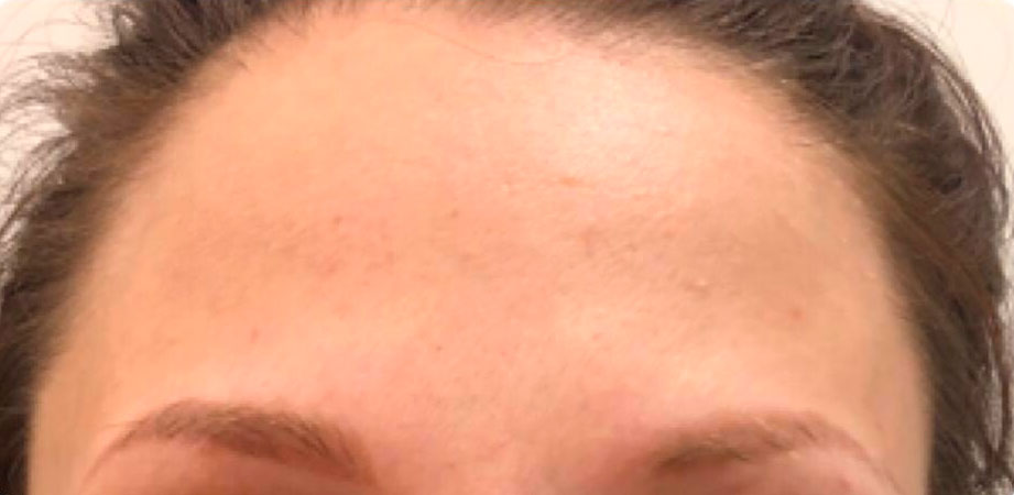 препараты Magiray для коррекции акне