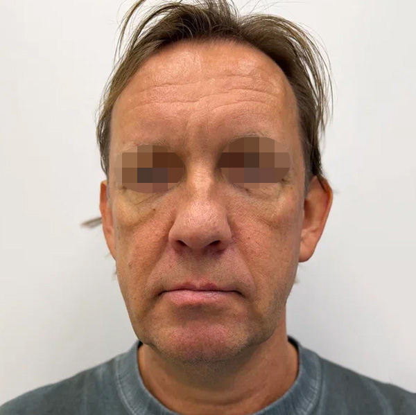 Neauvia Man, фото до и после