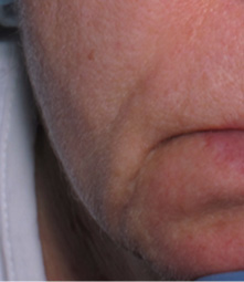 рельеф морщины