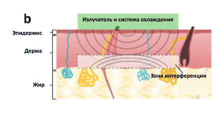 лечение гипергидроза на аппарате MiraDry