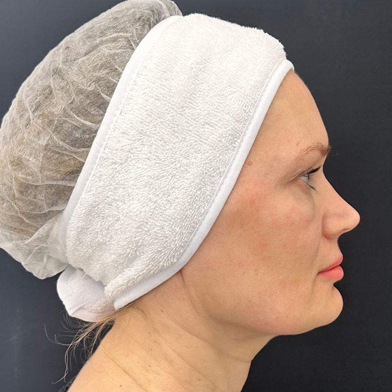 Протокол Bio-Mix Regenyal, фото до