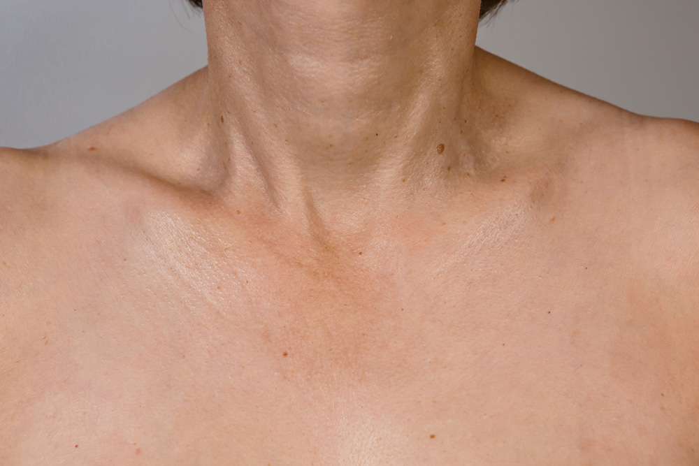 RRS® HA Long Lasting: декольте до