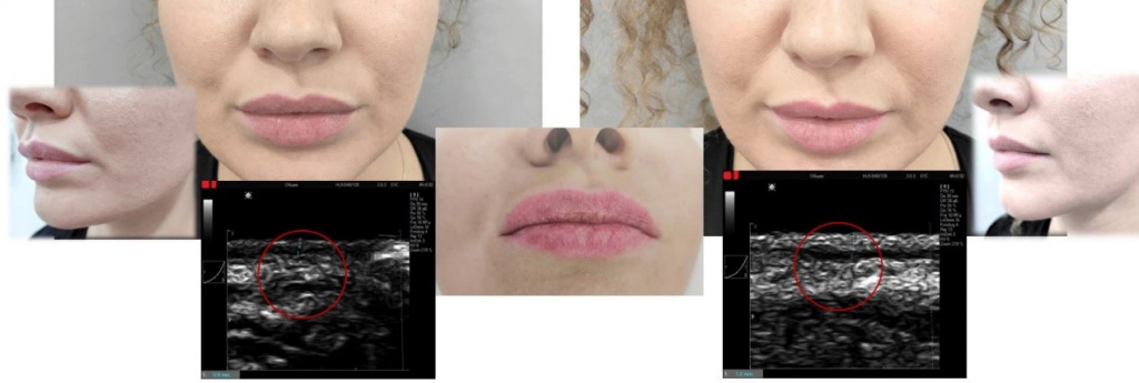 Протокол работы в зоне губ PicoCare