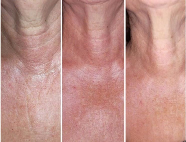 редермализация Hyalual в области шеи и зоны декольте